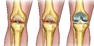 was ist eine Arthrose