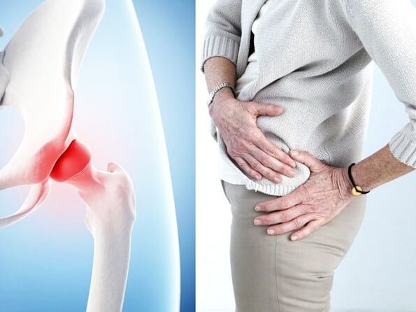 Symptome einer Arthrose des Hüftgelenks