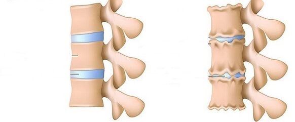 eine gesunde Wirbelsäule und Osteochondrose