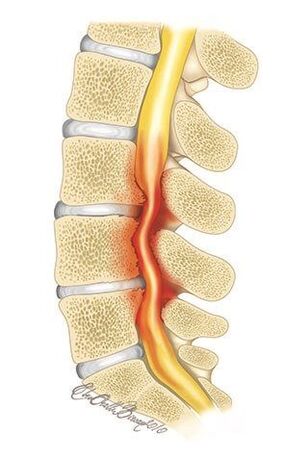 Bei Osteochondrose der Brustwirbelsäule kommt es zu einer Kompression des Wirbelkanals.