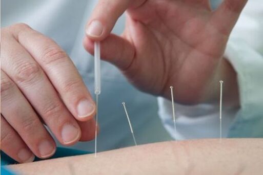 Akupunktur ist eine Methode zur Behandlung von Schmerzen in der Lendengegend, die durch Osteochondrose verursacht werden.