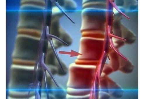Nervenenden bei lumbaler Osteochondrose zusammendrücken