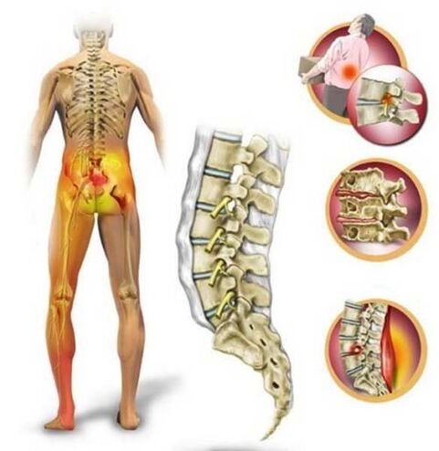 Osteochondrose der Lendenwirbelsäule, die Rückenschmerzen verursacht.
