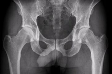 Diagnoseoptionen für Hüftgelenk -Arthrose