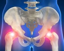 Die Ursachen der Arthrose des Hüftgelenks