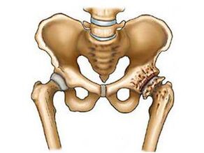 Was ist die Arthrose des Hüftgelenks