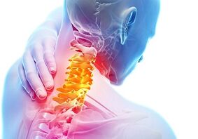 Die Hauptzeichen und Symptome einer zervikalen Osteochondrose