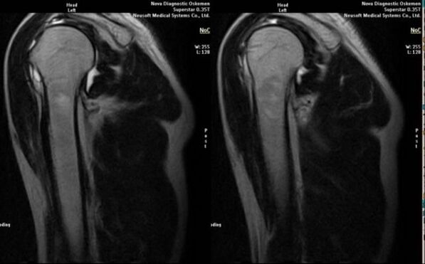 Röntgen zur Diagnose einer Schulterarthrose.