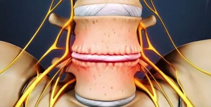 Wirbelsäulenverletzungen aufgrund von Osteochondrose.