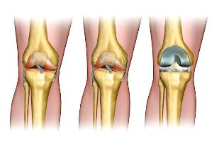der Grad der Arthrose