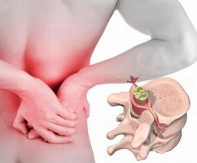 Hexenschuss am Anfang der Erkrankung Osteochondrose