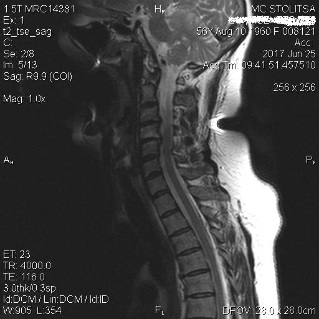 Osteochondrose und Spondylose der Halswirbelsäule